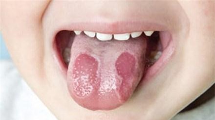 Khi lưỡi trẻ bị nấm gây biếng ăn và suy nhược cơ thể